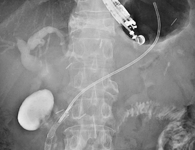 EUS-pancreatodrainageの画像3