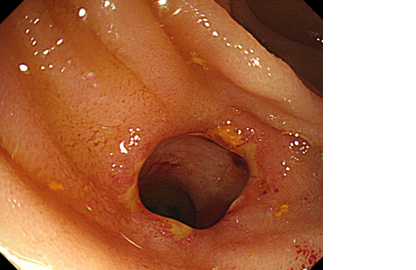 ERCPの画像10_03