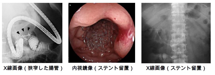 透視下消化器内視鏡の画像