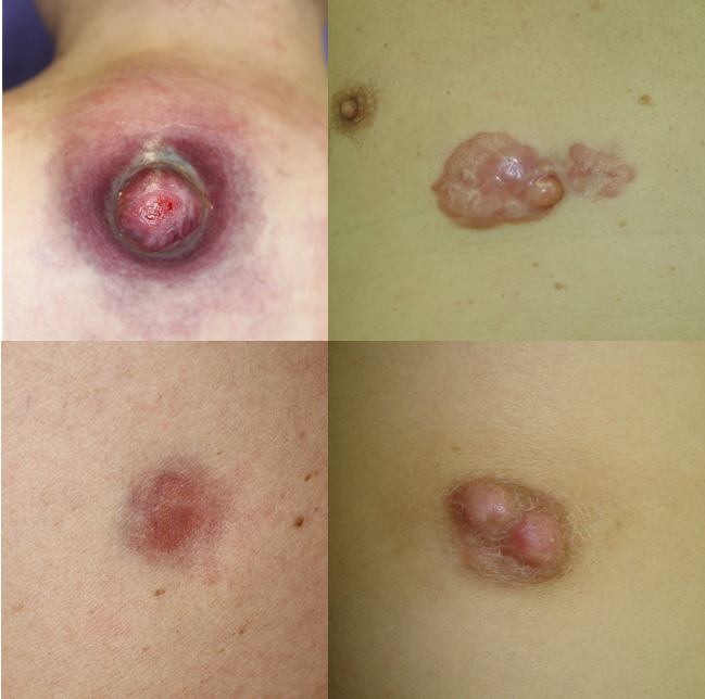 図9隆起性皮膚線維肉腫