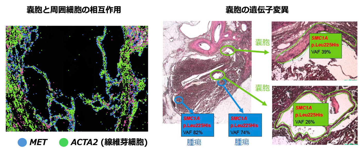 嚢胞と周囲細胞の相互作用と嚢胞の遺伝子変異の図